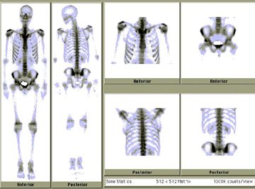 Nuclear Medicine bone scan images