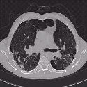 CT of chest showing lungs with pneumonia